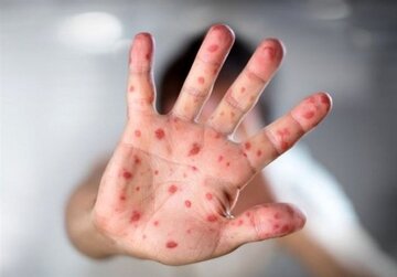 هزار مورد ابتلا به سرخک در سال جاری؛ اتباع خارجی در صدر آمار ابتلا