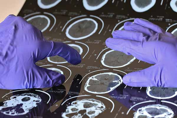 هشدار درباره آلزایمر در ایران: هر ۷ دقیقه یک نفر مبتلا می‌شود